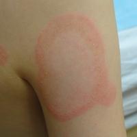 Diskoidni eritemski lupus: Zahvata kožu i može uzrokovati komplikacije
