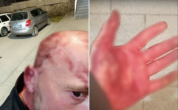 Bivši igrač Sarajeva Edin Pehlić i njegov kolega brutalno napadnuti: "Flašom me je udario po glavi, imam tri šava"