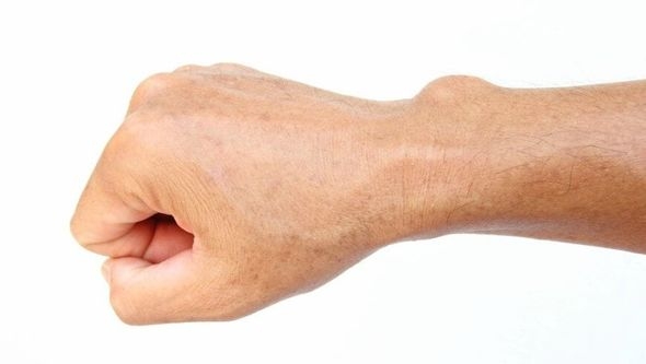 Otok na zglobu: Šta je higrom i kako se liječi?