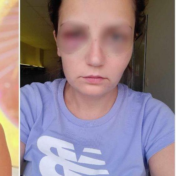 Enisa Klepo, djevojka koju je pretukao poslodavac u Jablanici, za "Avaz": Poderao mi je majicu i udario me je pesnicom  
